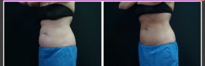CoolSculpting Before and Afters