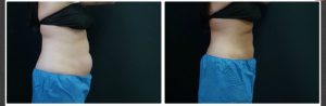 CoolSculpting Before and Afters